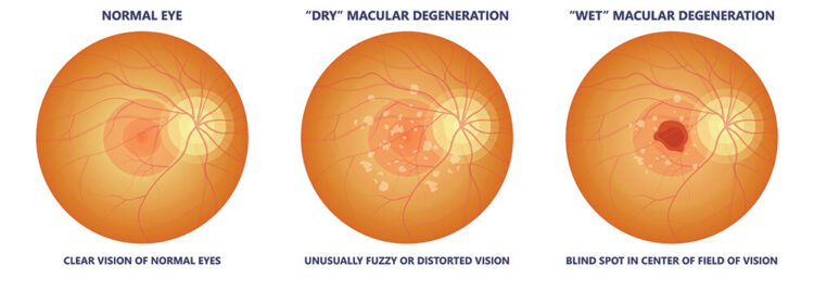 Macular Degeneration Memphis | Eye Disease Collierville - Southaven